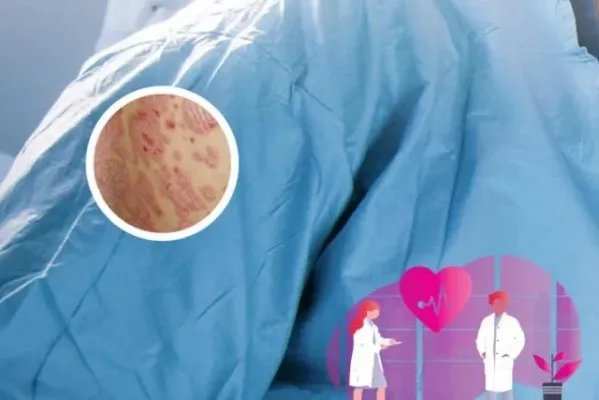 牛皮癣治疗用药