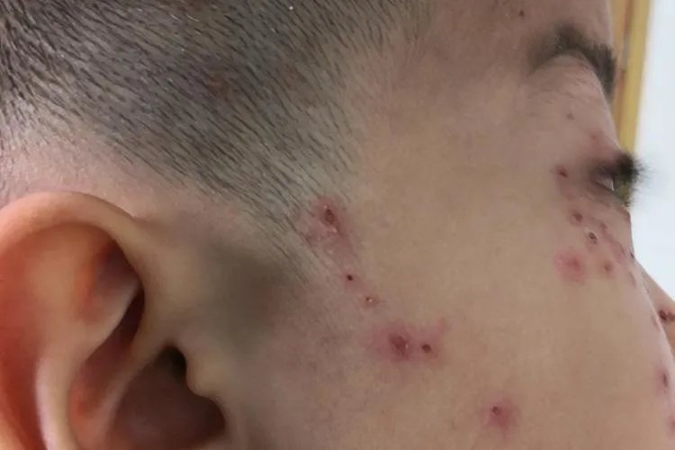 缠身龙皮肤病一般部位图片