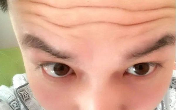 去抬头纹多久可以做一次