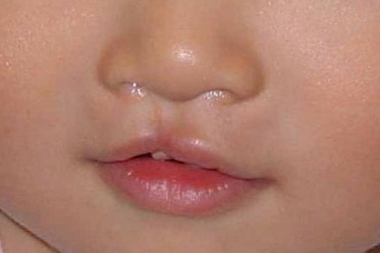 儿童兔唇图片