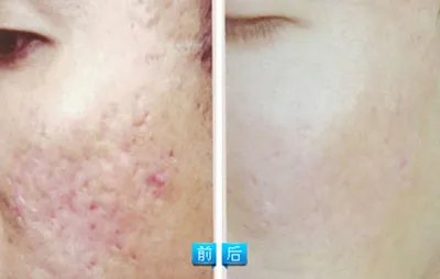 激光去痘疤多少钱