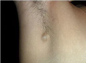 女腋下淋巴结肿大图片