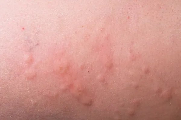 cd10什么细胞的标志