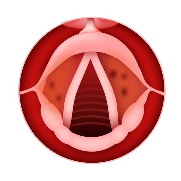 咽喉炎吃什么药好得快能根治