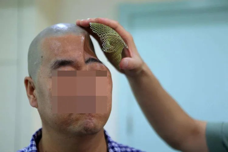 额头凹陷的图片