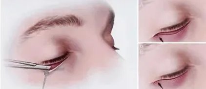 外切眼袋有风险吗？