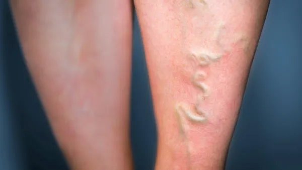 小腿静脉曲张的治疗方法