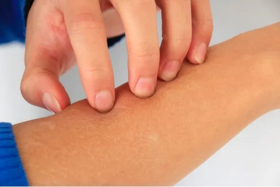 激素过敏性皮炎怎么办