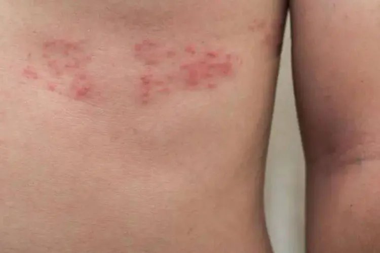 皮肤红疹图片