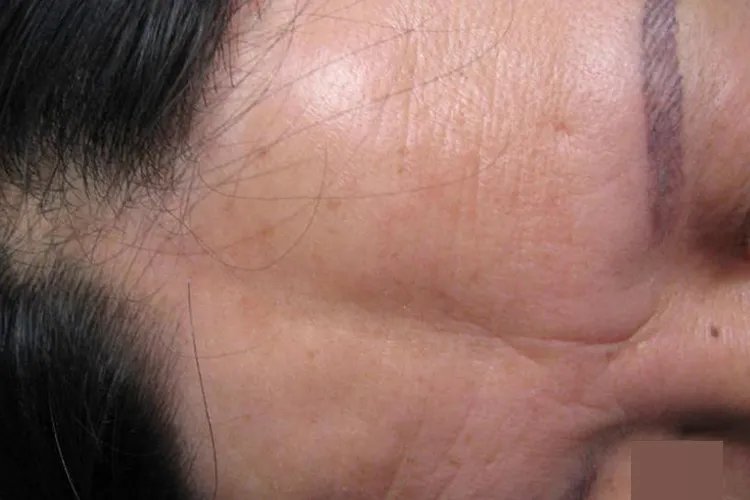 额头凹陷的图片