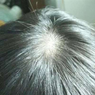 我的白发怎么治疗