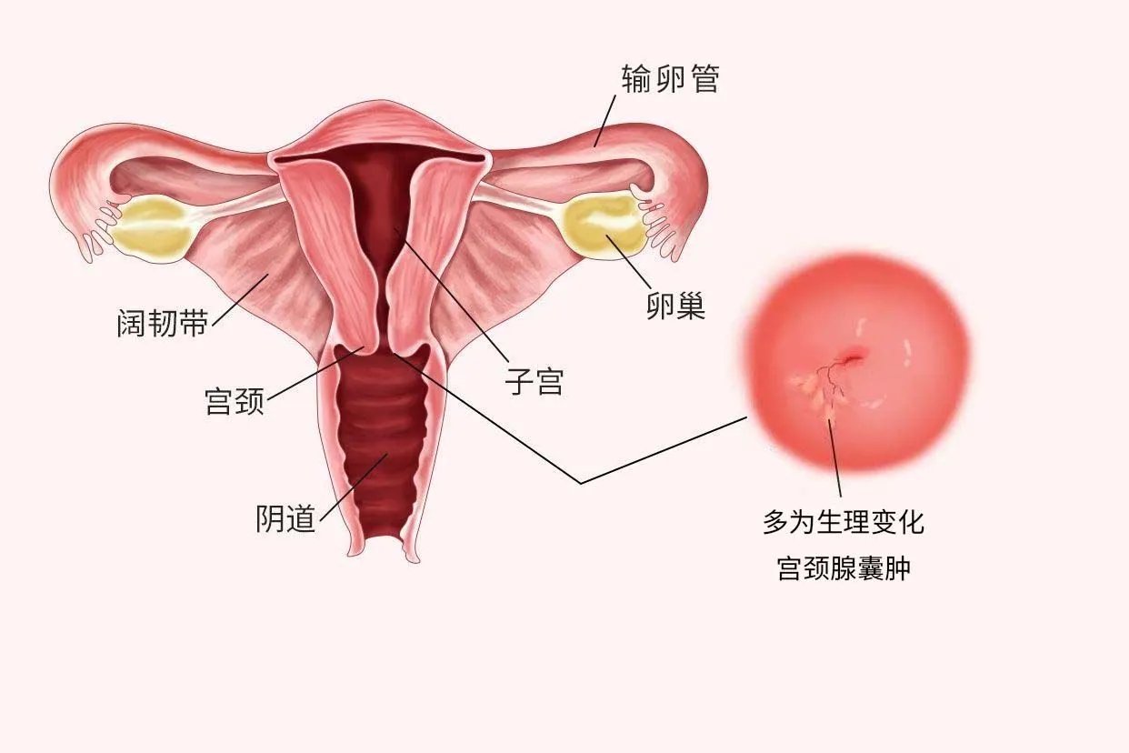 宫颈纳囊高清图片