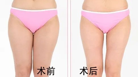 吸脂瘦腿的价格一般是多少钱