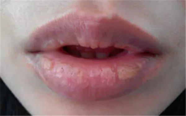 嘴唇上火怎么办