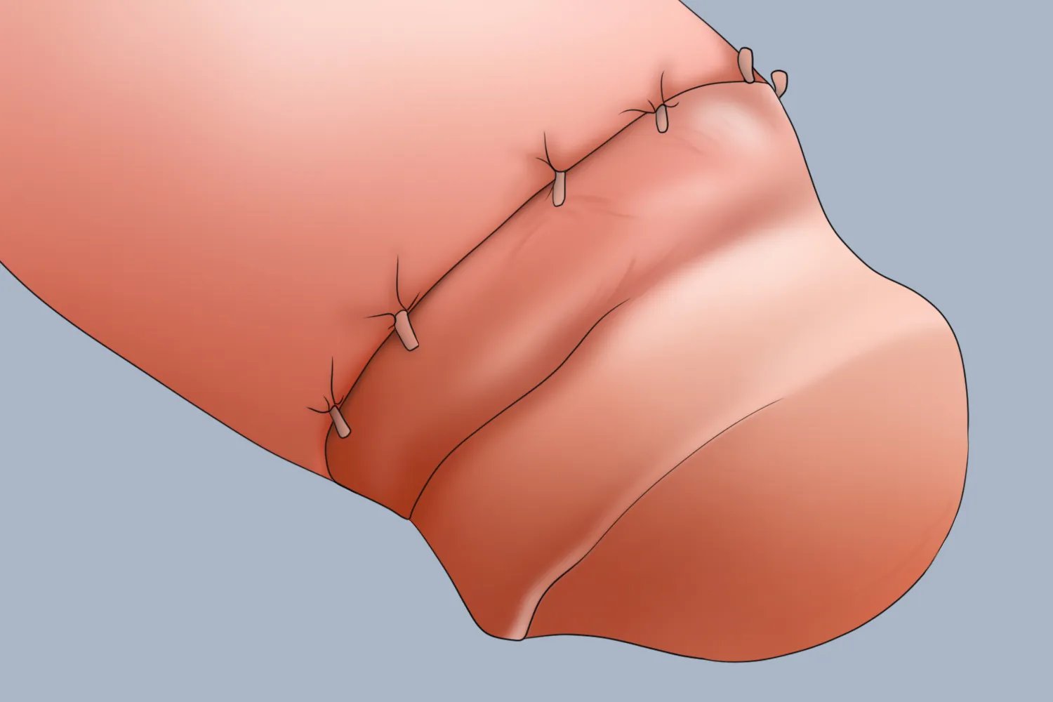 男性割包皮正常的图片
