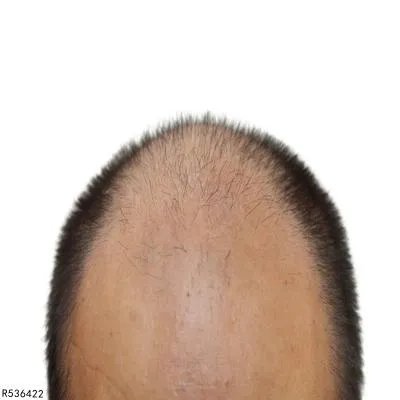 斑秃吃什么药效果最好 四种口服药帮助治疗斑秃