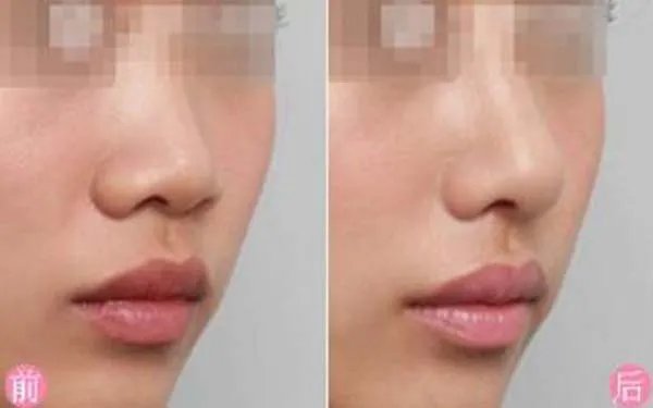 假体隆鼻整形天津哪家医院最好