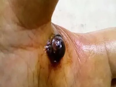 放射后血管肉瘤肿块图片