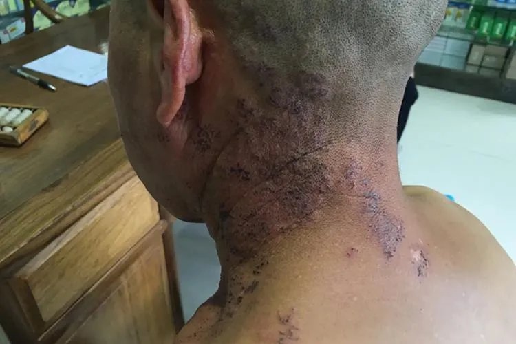 缠身龙皮肤病一般部位图片