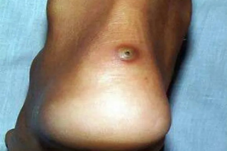 蚤病脚后跟小疙瘩图片