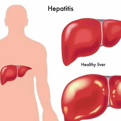 快速得肝癌药有哪些