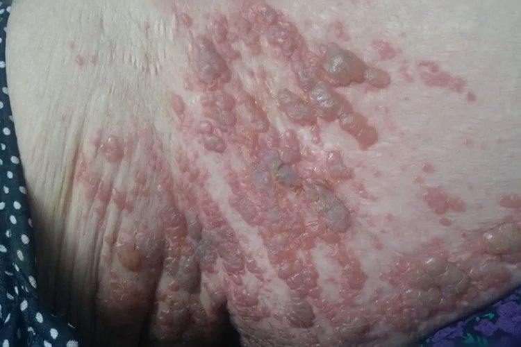 缠身龙皮肤病一般部位图片