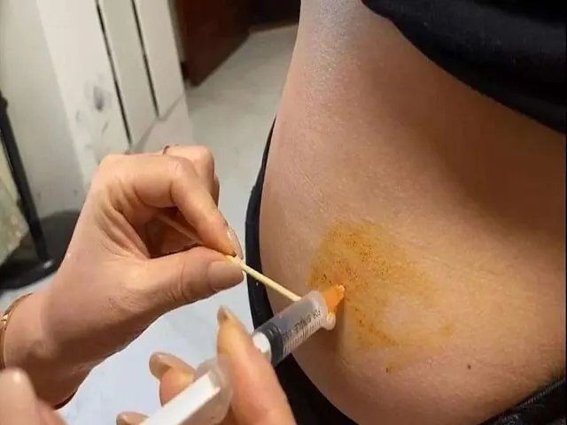 有去日本杉山医院做试管成功的攻略分享吗？