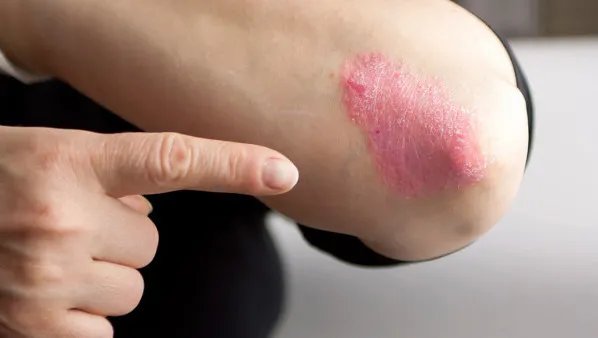 牛皮癣吃什么药