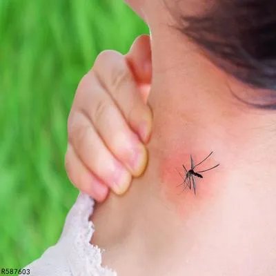 怎么缓解蚊虫叮咬的痒