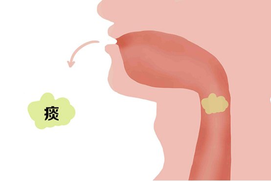 痰多是什么原因造成的