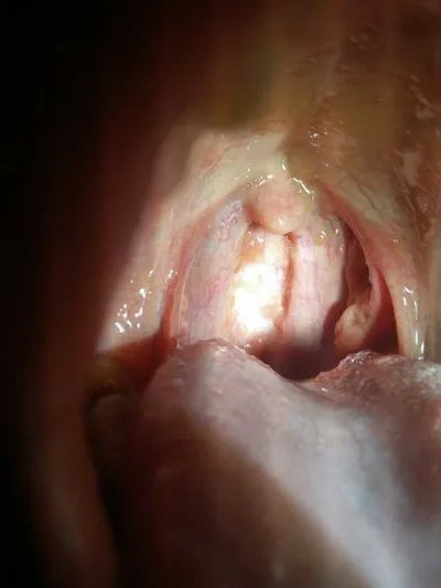 呼吸衰竭的症状?