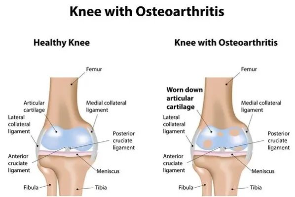 北京大学第三医院骨科关节学组成立20年