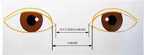 开眼角手术价格受什么影响？