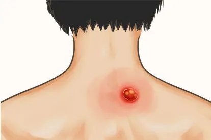 火疖子前期图片