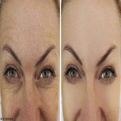 如何预防老年斑 做好四个预防延缓老年斑出现