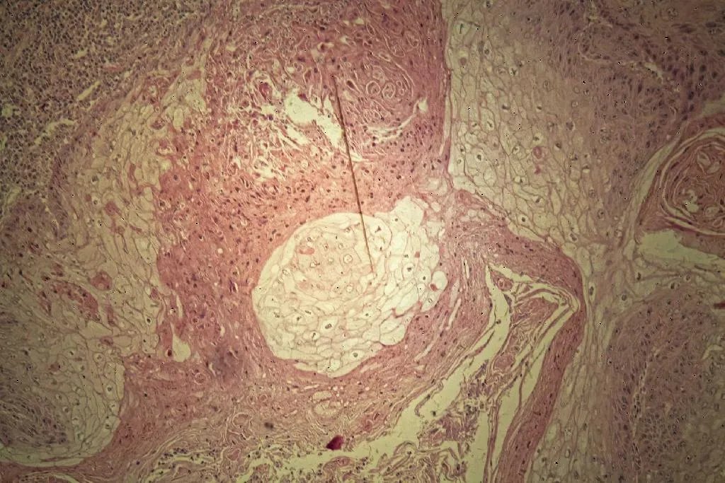 鳞状细胞癌图片