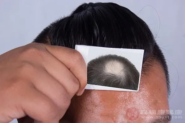脱发怎么治疗