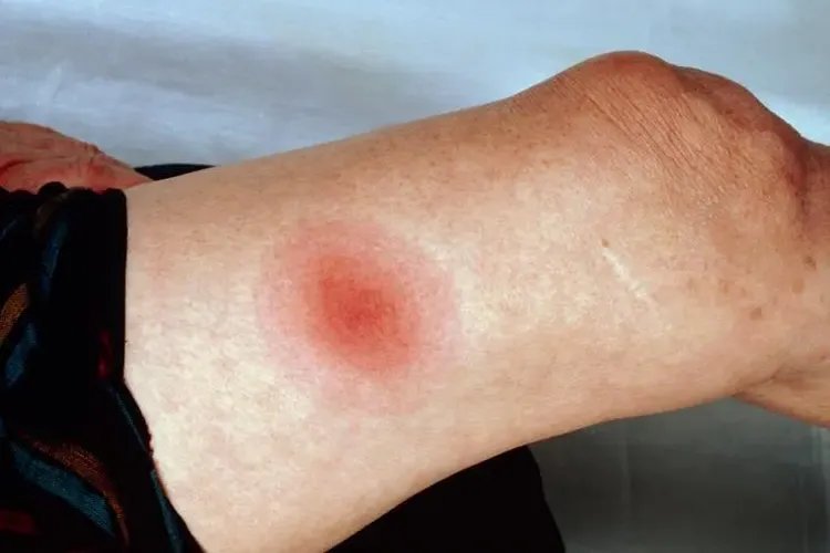 莱姆病早期症状图片