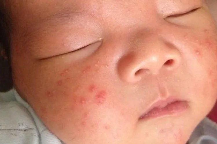 皮肤红疹图片