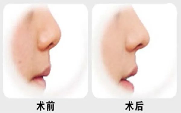 假体隆鼻整形天津哪家医院最好