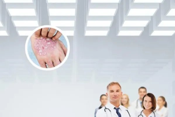 牛皮癣治疗用药