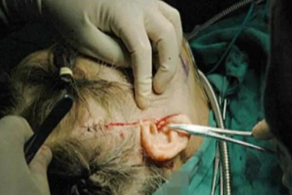 大拉皮手术图片