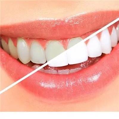 镶牙的种类是哪些