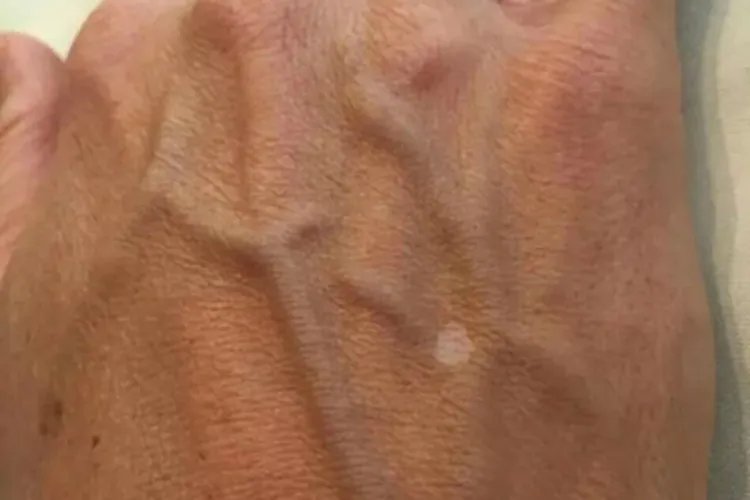 特发性点状色素减退斑手背症状图片