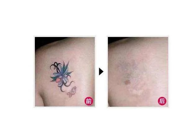 彩色纹身能洗掉吗