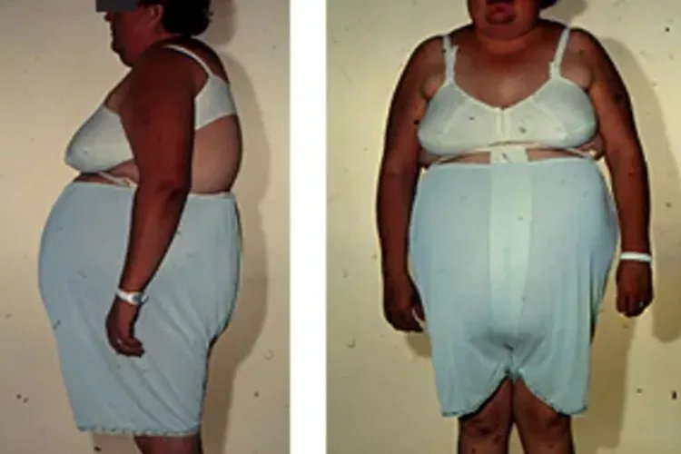 水牛背患者图片