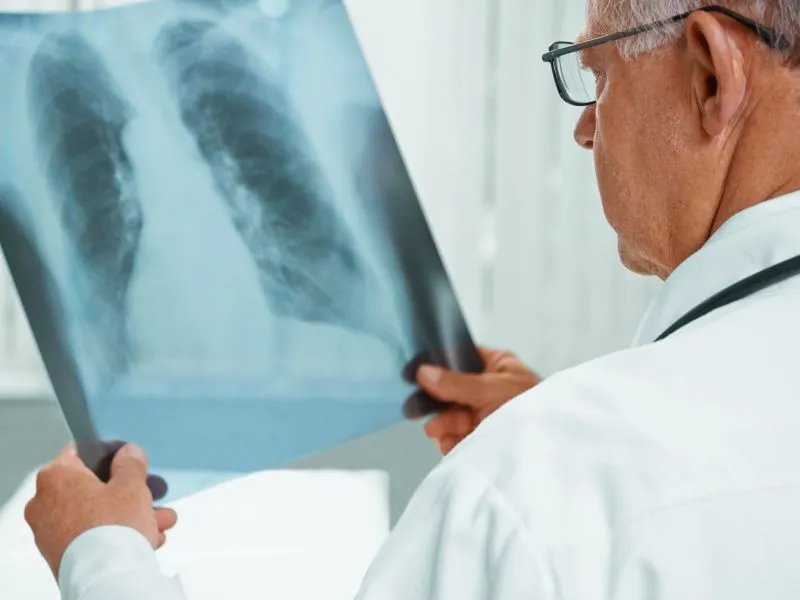 肺癌的晚期症状