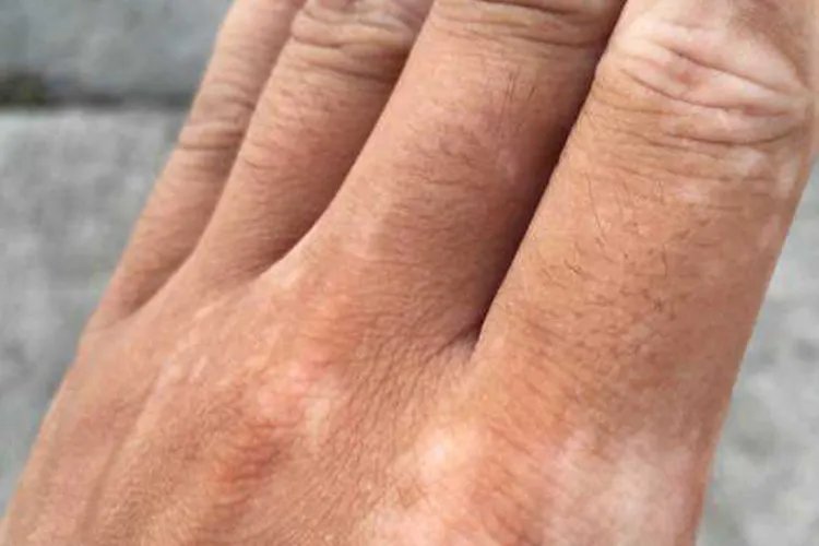 手上白斑最初期的图片