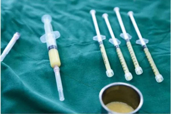 全脸脂肪填充几天消肿?究竟全脸脂肪填充多久可以恢复自然